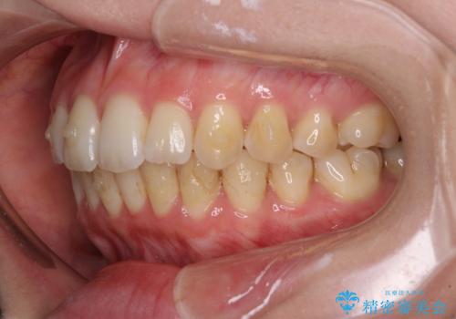 前歯のデコボコを解消 インビザラインによる矯正治療の治療中