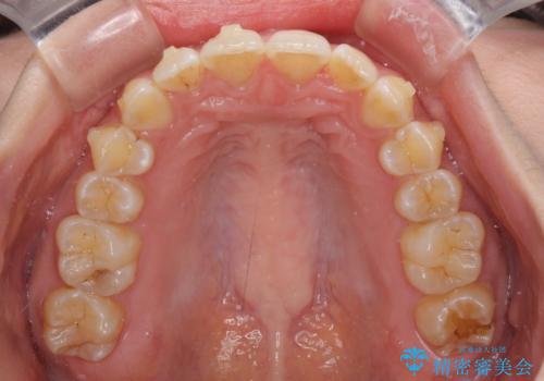 前歯のデコボコを解消 インビザラインによる矯正治療の治療中