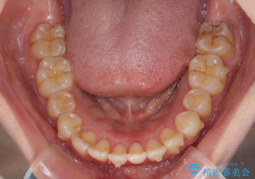 前歯のデコボコを解消　インビザラインによる矯正治療の治療中