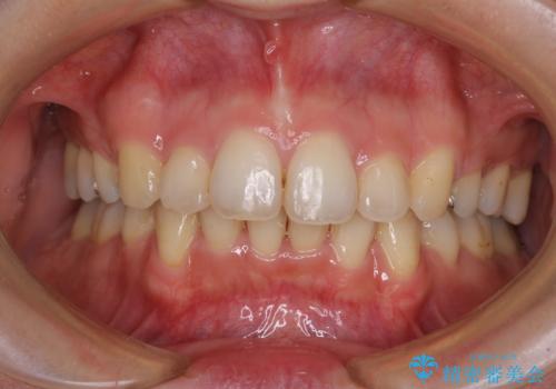 閉じにくい口元　前歯を引っ込める抜歯矯正の症例 治療後