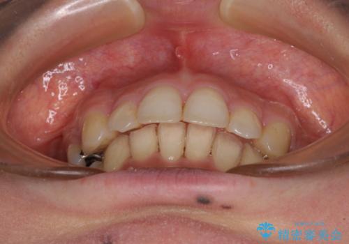 閉じにくい口元 前歯を引っ込める抜歯矯正の治療後