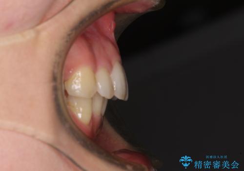 閉じにくい口元 前歯を引っ込める抜歯矯正の治療後