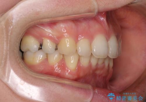 閉じにくい口元 前歯を引っ込める抜歯矯正の治療後