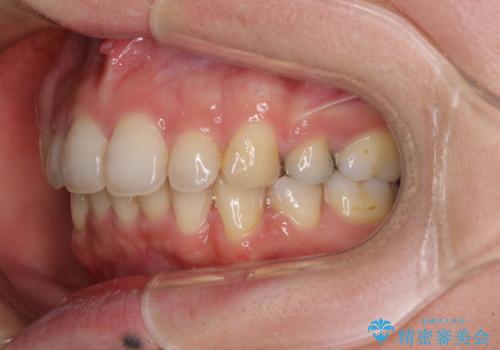 閉じにくい口元　前歯を引っ込める抜歯矯正の治療後
