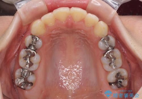 閉じにくい口元 前歯を引っ込める抜歯矯正の治療後