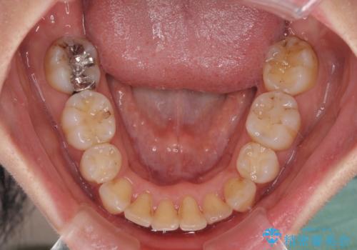 閉じにくい口元 前歯を引っ込める抜歯矯正の治療後