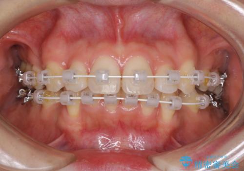 閉じにくい口元 前歯を引っ込める抜歯矯正の治療中