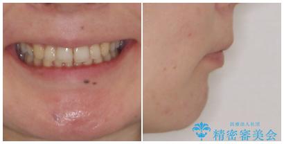 閉じにくい口元 前歯を引っ込める抜歯矯正の治療後(顔貌)