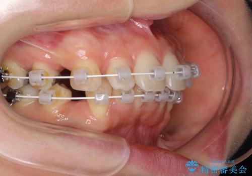 閉じにくい口元 前歯を引っ込める抜歯矯正の治療中