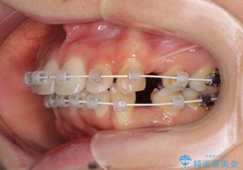 閉じにくい口元 前歯を引っ込める抜歯矯正の治療中