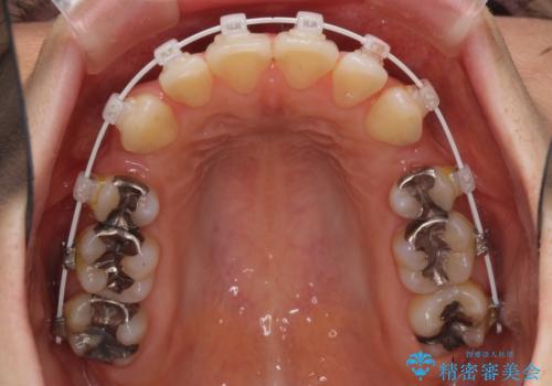 閉じにくい口元　前歯を引っ込める抜歯矯正の治療中