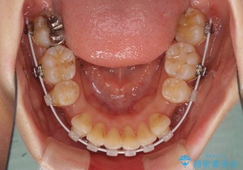 閉じにくい口元 前歯を引っ込める抜歯矯正の治療中