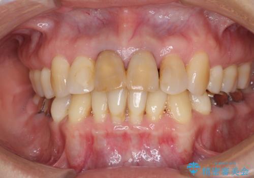 部分矯正とセラミック 前歯の審美治療の症例 治療前