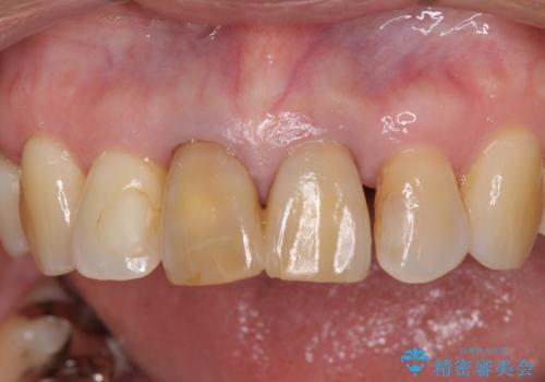 部分矯正とセラミック 前歯の審美治療の治療前