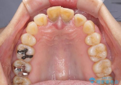 部分矯正とセラミック　前歯の審美治療の治療前