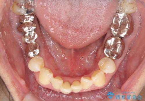 部分矯正とセラミック 前歯の審美治療の治療前