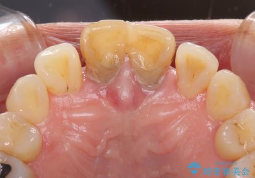 部分矯正とセラミック 前歯の審美治療の治療前