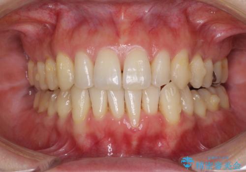 八重歯のインビザライン矯正治療の治療中