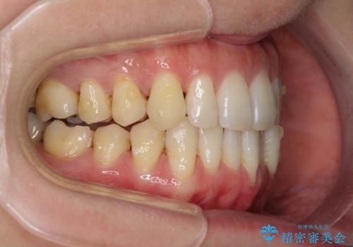 八重歯のインビザライン矯正治療の治療中