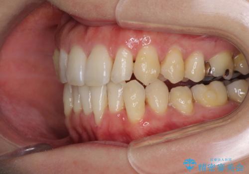 八重歯のインビザライン矯正治療の治療中