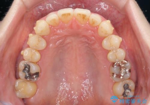 八重歯のインビザライン矯正治療の治療中