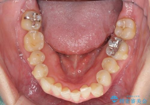八重歯のインビザライン矯正治療の治療中