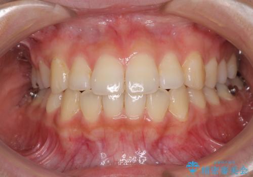 前歯の突出感とデコボコ インビザラインで改善の治療中