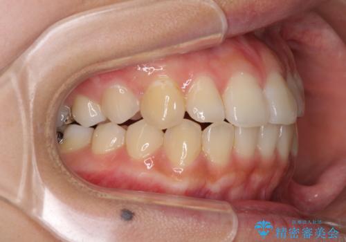 前歯の突出感とデコボコ インビザラインで改善の治療中