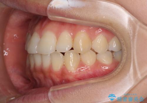 前歯の突出感とデコボコ インビザラインで改善の治療中