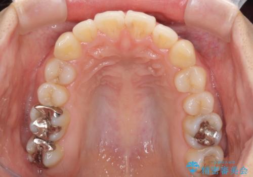 前歯の突出感とデコボコ　インビザラインで改善の治療中