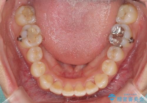 前歯の突出感とデコボコ　インビザラインで改善の治療中