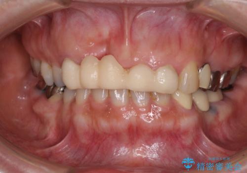汚い仮歯で困っている　前歯のオールセラミックブリッジの治療前