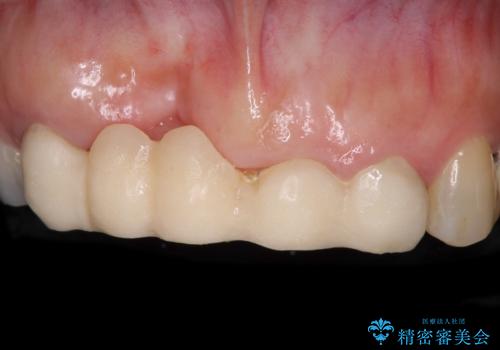 汚い仮歯で困っている 前歯のオールセラミックブリッジの症例 治療前