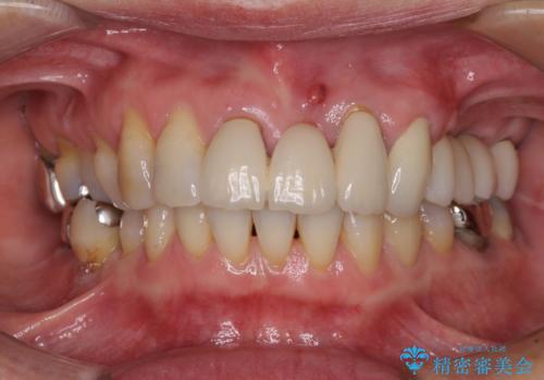 ブリッジの土台が割れて痛い インプラントによる補綴治療の治療後