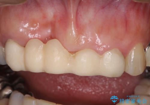 汚い仮歯で困っている 前歯のオールセラミックブリッジの治療前