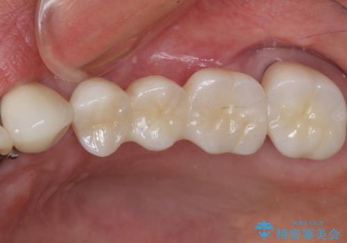 ブリッジの土台が割れて痛い インプラントによる補綴治療の症例 治療後