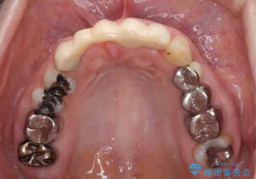 汚い仮歯で困っている 前歯のオールセラミックブリッジの治療前