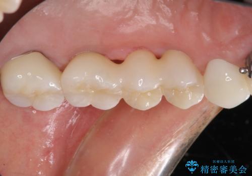 ブリッジの土台が割れて痛い インプラントによる補綴治療の治療後