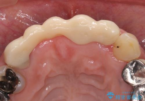 汚い仮歯で困っている 前歯のオールセラミックブリッジの治療前