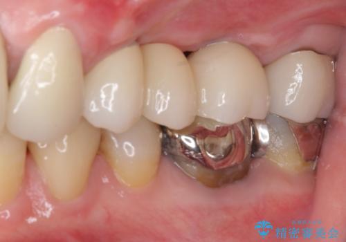 ブリッジの土台が割れて痛い インプラントによる補綴治療の治療後
