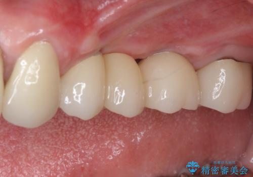 ブリッジの土台が割れて痛い インプラントによる補綴治療
