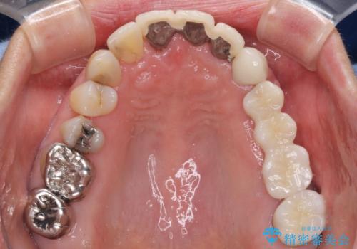 ブリッジの土台が割れて痛い インプラントによる補綴治療の治療後