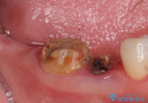 インプラント　咬めない奥歯の治療の治療前