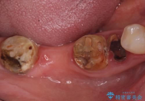 インプラント　咬めない奥歯の治療の症例 治療前