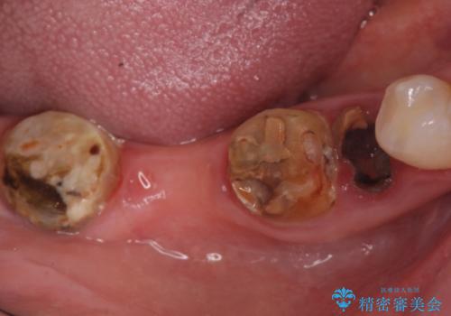 インプラント　咬めない奥歯の治療の治療前