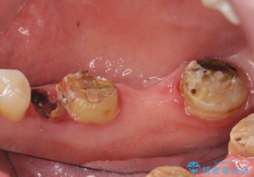 インプラント　咬めない奥歯の治療の治療前