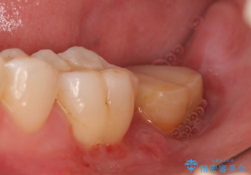 歯冠延長術　他院にてクラウンが入れられないと言われた歯の治療の治療後