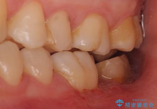 歯冠延長術 他院にてクラウンが入れられないと言われた歯の治療の治療後