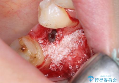 インプラント　咬めない奥歯の治療の治療中