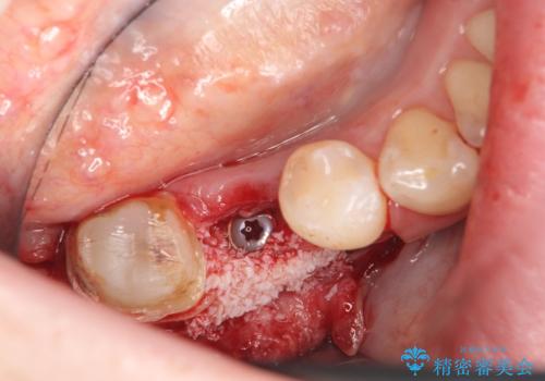 インプラント　咬めない奥歯の治療の治療中